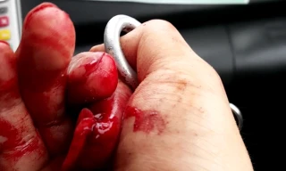 Ngón tay trỏ phải của nhà báo Đỗ Doãn Hoàng bị thương tích nặng. Ảnh: Nhân vật cung cấp