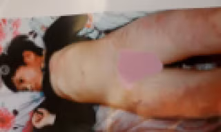 Hình ảnh cháu Dương bị bầm tím khắp người (ảnh do gia đình cung cấp) 