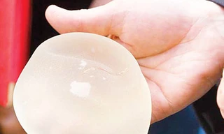 Nghi vấn túi nâng ngực gây ung thư