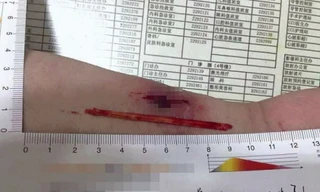 Đoạn đũa dài 8cm trong tay ông Zeng.