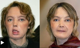 Hình ảnh Isabelle Dinoire sau (trái) và trước phẫu thuật.