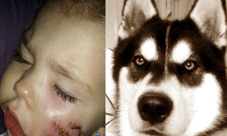 Bé gái 3 tuổi bị chó cắn nát 1 bên mặt