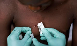 Bệnh đậu mùa khỉ lan nhanh ở châu Âu, WHO họp khẩn