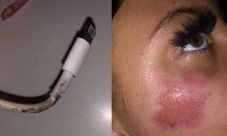 Thiếu nữ bị bỏng mặt vì iPhone bất ngờ phát nổ khi cắm sạc qua đêm