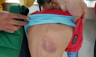 Bé trai lớp 2 bị cô giáo chủ nhiệm đánh bầm tím người
