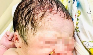 Hy hữu bé trai chào đời cùng vòng tránh thai của mẹ