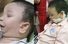 Kéo dãn xương hàm điều trị dị tật bẩm sinh