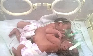 Cặp song sinh dính nhau đang được chăm sóc đặc biệt tại khoa Hồi sức Bệnh viện Việt Đức. Ảnh hai bé lúc mới chào đời do bệnh viện cung cấp. 