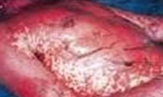 Làm gì khi bị dị ứng với thuốc trị gout?