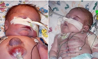 Cậu bé có trái tim ngoài cơ thể