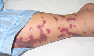 Não mô cầu lan ra miền Bắc