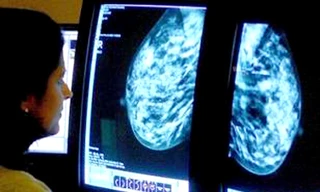 Ung thư vú ủ bệnh từ trước 11 tuổi