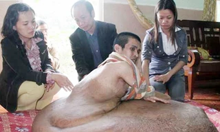 Giải cứu người có khối u 80 kg