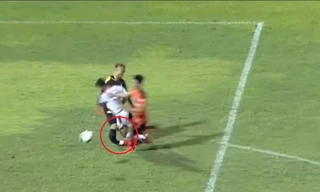 Thủ môn Đà Nẵng bị gãy cả 2 xương ống chân, nghỉ thi đấu 1 năm 