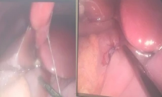 Hình ảnh trước và sau khi phẫu thuật mổ nội soi. Ảnh: Bệnh viện Trẻ em Hải Phòng