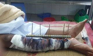 Ngư dân Đỗ Đức Long bị tấn công gãy dập chân và đa chấn thương vùng đầu.