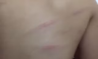 Nhiều vết thương trên lưng em Ng. được gia đình phát hiện