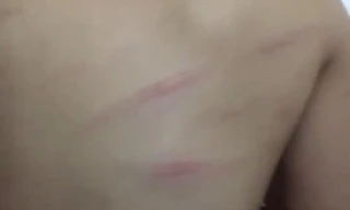 Nhiều vết thương trên lưng em Ng. được gia đình phát hiện