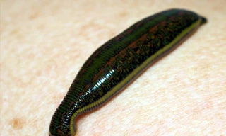 Gắp con đỉa dài 10 cm ra khỏi hốc mũi người phụ nữ