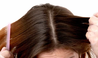 Mẹo hay loại bỏ gàu tự nhiên và hiệu quả