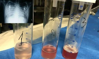 Ho ra máu lúc 4 tuổi, 9 năm sau mới phát bệnh hiếm gặp