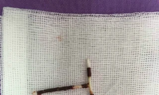 Vòng tránh thai được lấy ra khỏi bụng bệnh nhân. Ảnh bệnh viện cung cấp 