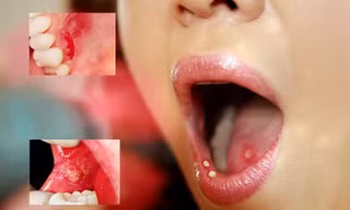 Ăn cay nóng mùa đông, làm sao để xử lý nhiệt miệng?