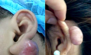 Sẹo lồi to bằng quả chanh chỉ vì bấm lỗ tai