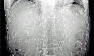  Tín đồ sushi bị sán 'làm ổ' khắp người