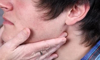 Tưởng cảm cúm hóa ra ung thư vòm họng