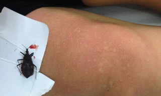 Nổi mề đay, tăng nhịp tim vì bọ xít đốt