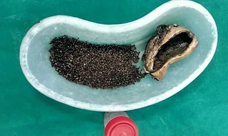 Ảnh: Hơn 4.000 viên sỏi được gắp ra từ túi mật của bệnh nhân. 
