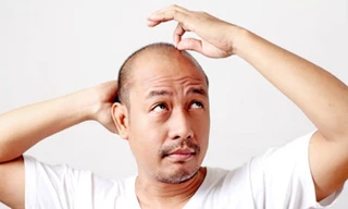 Những bệnh đàn ông hói đầu dễ mắc phải