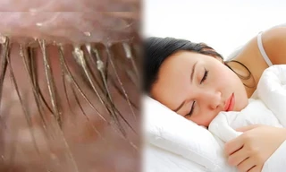 Kinh hoàng 100 con bọ trên lông mi vì… 5 năm không giặt vỏ gối