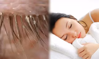 Kinh hoàng 100 con bọ trên lông mi vì… 5 năm không giặt vỏ gối
