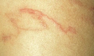 Những nốt sẩn ngoằn ngoèo dưới da ở bệnh nhân nhiễm giun lươn mạn. Ảnh: T.H. 