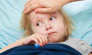  Trị sởi theo đông y