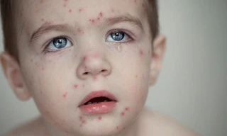 Thủy đậu, quai bị vào mùa: Chớ coi thường