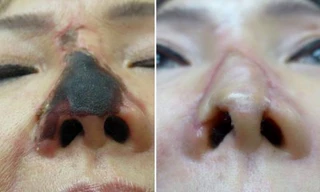  Bị hoại tử mũi sau khi tiêm chất làm đầy