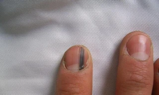 Phát hiện dấu hiệu ung thư tiềm ẩn qua móng tay, tóc, răng...