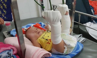 Bé trai 4 tháng tuổi nghi bị cha đánh xuất huyết não