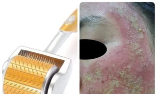 Mất 40 triệu đồng lăn kim làm đẹp, người phụ nữ rước hoạ vì mặt thành ổ mủ