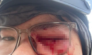 Xác minh vụ nam thanh niên tố bị gậy CSGT 'va' vào mắt 