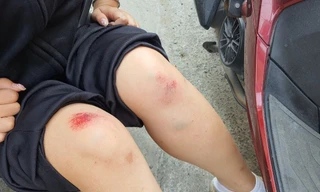 Giữa ban ngày, cô gái trẻ bị giật túi xách ngã nhào xuống đường