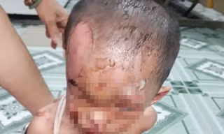 Nghi vấn bé trai ở TPHCM bị cha mẹ đánh đập dã man, trên người đầy vết thương