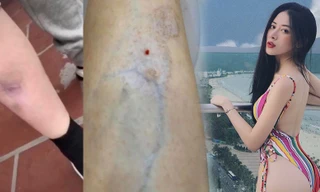 Hot girl bị teo cơ, giãn tĩnh mạch chân vì thẩm mỹ