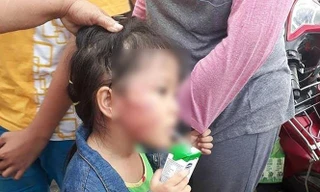 Bé Chi (5 tuổi) với thương tích trên mặt nghi bị cô giáo bạo hành. Ảnh: Người nhà cung cấp 