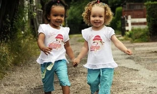 Kỳ lạ cặp sinh đôi một da đen, một da trắng cực hiếm gặp