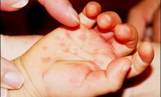 Dấu hiệu điển hình trẻ mắc tay chân miệng