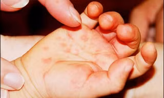 Dấu hiệu điển hình trẻ mắc tay chân miệng